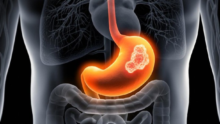 Gejala Kanker Lambung yang Harus Diwaspadai, Kerap Diabaikan gegara Mirip GERD