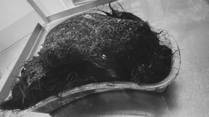 Dokter Keluarkan Gumpalan Rambut Raksasa dari Perut Bocah 14 Tahun