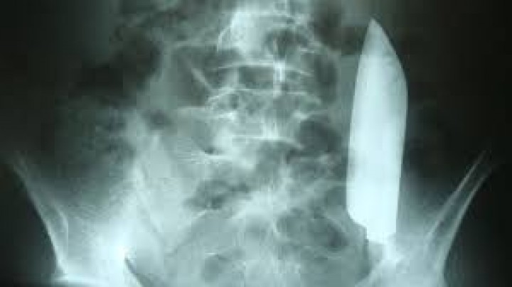 Ngilu! Dokter Temukan Pisau 17 Cm di Usus Pasien, Ternyata Ini Awal Mulanya