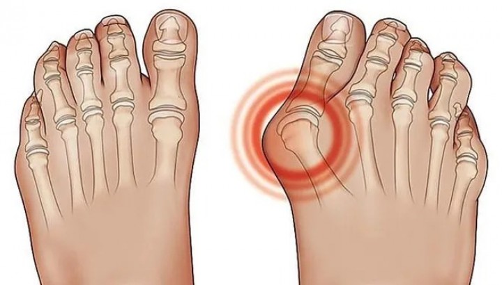 Penderita Asam Urat Wajib Tahu! Segini Jumlah Air yang Wajib Dikonsumsi Biar Aman