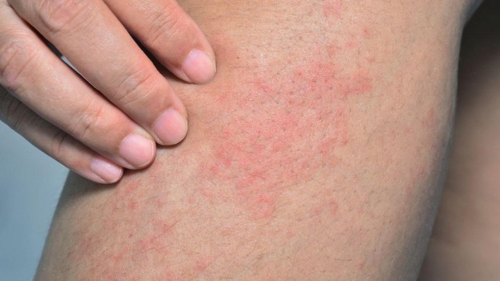 Penyebab Gatal pada Kulit Tak Kunjung Sembuh, Jangan Dianggap Sepele!